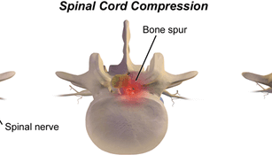 Bone spur causing spinal stenosis 