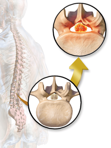 Spinal Stenosis - Nashville chiropractor