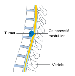 Tumor causing spinal stenosis